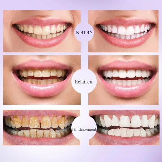 Dentifrice Blanchissant V34 effet dent blanche